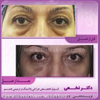 فیلم نمونه واقعی جراحی بلفاروپلاستی پلک پایین خانم 50 ساله