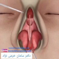 فیلم جراحی بینی به روش باز