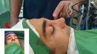 فیلم  قبل و بلافاصله بعد از پایان جراحی بینی