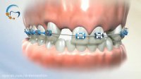 ایمپلنت در ارتودنسی | دکتر مسعود داوودیان