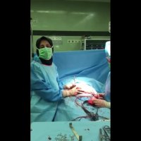 فیلم عمل خارج کردن فیبروم رحم