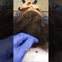 اسکالپ روشی نوین برای رفع طاسی و کم پشتی موی سر