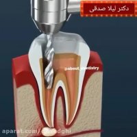 درمان عصب کشی دندان