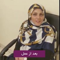 دو ماه بعد از جراحی بینی و رضایت بیمار