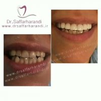 💥اصلاح طرح لبخند فک بالا💥