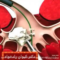 خارج کردن سنگ کلیه