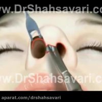 جراحی زیبایی بینی