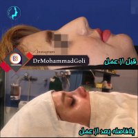 نتیجه جراحی بینی بلافاصله پس از عمل | دکتر گلی