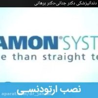 نصب براکت های ارتودنسی