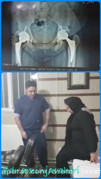 معاينه بيمار يكسال بعداز عمل جراحي تعويض مفصل دوطرفه لگن