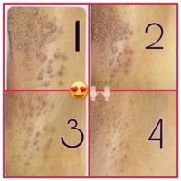 زگیل تناسلی زنان