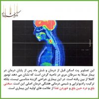 علائم اولیه سرطان مری