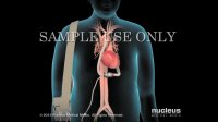 Left Ventricular Assist Device | LVAD | Nucleus Health