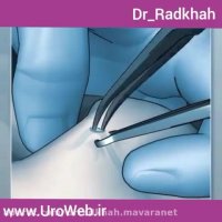 جراحی وازووازوستومی میکروسکوپیک