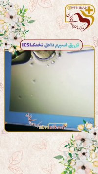 تزریق اسپرم داخل تخمک ICSI