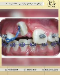 قبل و بعد ارتودنسی ثابت | دندانپزشکی سیمادنت