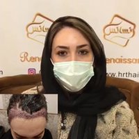 کاشت ابرو طبیعی در سعادت آباد