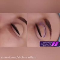 جراحی زیبایی پلک