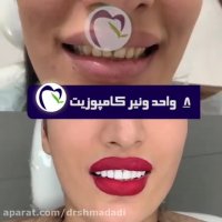 فیلم گذاشتن ونیر کامپوزیت روی 8 واحد دندان