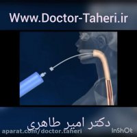 بالن گذاری داخل معده