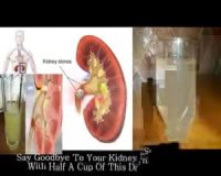 جدید ترین درمان سنگ کلیه به راحتی