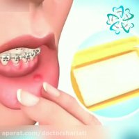 استفاده از موم برای جلوگیری از زخم شدن دهان