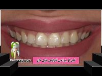 جراحی لثه برای کمتر دیده شدن لثه