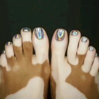 آیا کرم یا پماد پیسی را درمان میکند ؟