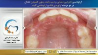 ارتودنسی بدون کشیدن دندان | دکتر داوودیان