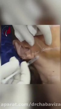 فیلم لیفت صورت با نخ توسط دکتر چعباوی زاده