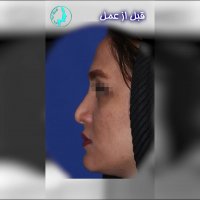 نمونه جراحی ترمیمی بینی | دکتر محمد گلی