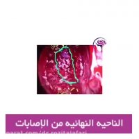 انکسارات عظام المخ