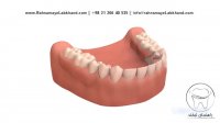 پروتز پارسیل دندان