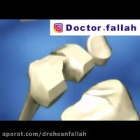 تعویض مفصل زانو