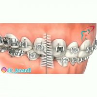 نحوه مسواک زدن در دوران ارتودنسی