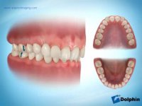 درمان ارتودنسی دیپ بایت | دکتر مسعود داوودیان