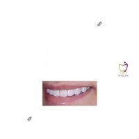 نمونه ای از عمل زیبایی دندان