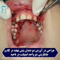 جراحی در آوردن دو دندان نیش نهفته