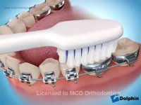 مسواک مخصوص ارتودنسی | دکتر مسعود داودیان