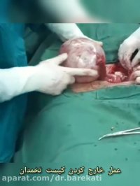 عمل خارج کردن کیست تخمدان