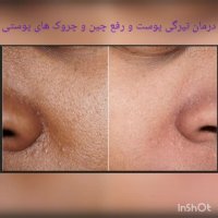 کرم لازان جهت آبرسانی و جوانسازی پوست