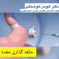 انیمیشن حلقه گذاری معده