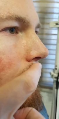 عمل زیبایی بینی اروپایی از هلند دکتر نسرین راستا 09337174804