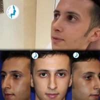 رضایت بیمار چهل و یک روز بعد از جراحی بینی