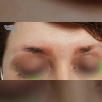 کاشت ابرو با وجود هاشور قدیمی