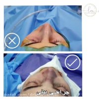 بلافاصله پس از جراحی زیبایی بینی
