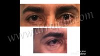 رتركشن یا كشیدگی پلك تحتانی به سمت پایین به دنبال جراحی