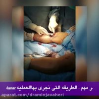 عملیه الرکبه المقوسه