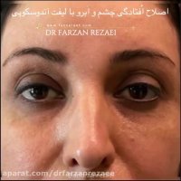 نمونه ای از جراحی لیفت ابرو با اندوسکپ