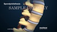 Back Surgery | Spinal Fusion | Nucleus Health